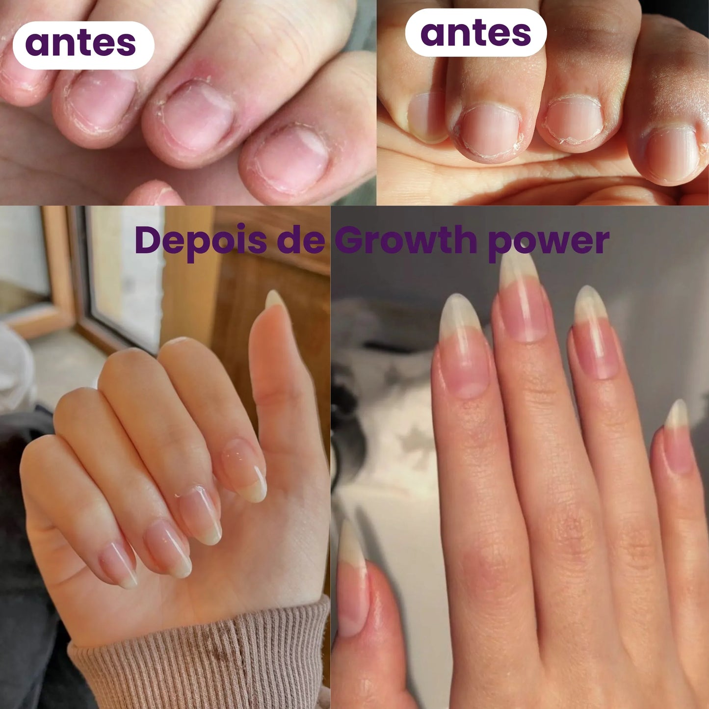 Kit Growth Power com 1 Tônico Capilar e 1 Vitamina para tratamento completo de 1 mês; Combinação de Tônico Growth Power e Vitamina Growth Power para crescimento saudável de cabelos e unhas; Mulher aplicando Tônico Growth Power no couro cabeludo e segurando cápsulas da Vitamina Growth Power; Kit completo com múltiplas unidades de Tônico e Vitamina para tratamento prolongado; Antes e depois do uso do kit Growth Power mostrando cabelos mais fortes, densos e volumosos; Embalagem do Tônico e Vitamina