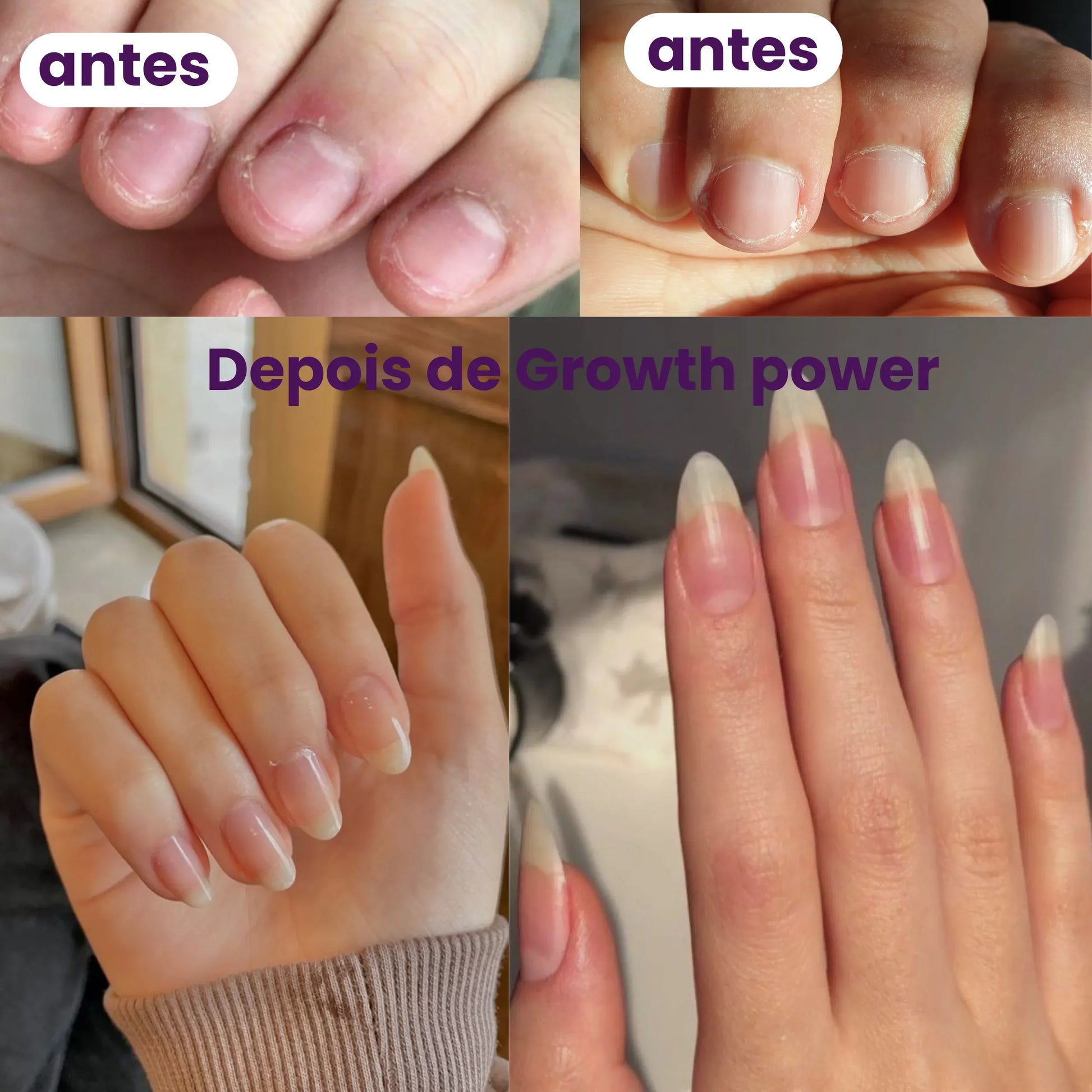 Kit Growth Power com 1 Tônico Capilar e 1 Vitamina para tratamento completo de 1 mês; Combinação de Tônico Growth Power e Vitamina Growth Power para crescimento saudável de cabelos e unhas; Mulher aplicando Tônico Growth Power no couro cabeludo e segurando cápsulas da Vitamina Growth Power; Kit completo com múltiplas unidades de Tônico e Vitamina para tratamento prolongado; Antes e depois do uso do kit Growth Power mostrando cabelos mais fortes, densos e volumosos; Embalagem do Tônico e Vitamina